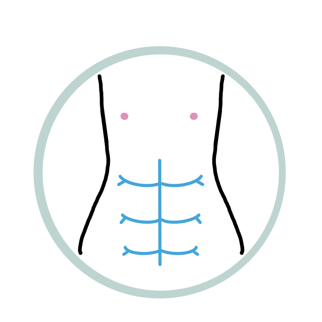 Abdominoplastia